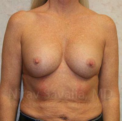 Breast Implant Revision Before & After Gallery - Patient 1655444
