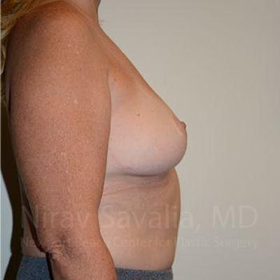Breast Lift without Implants Before & After Gallery - Patient 1655446 - After1