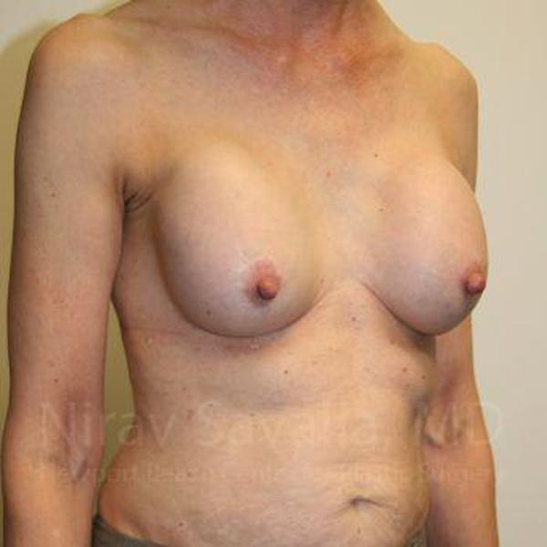 Breast Implant Revision Before & After Gallery - Patient 1655447 - Before1
