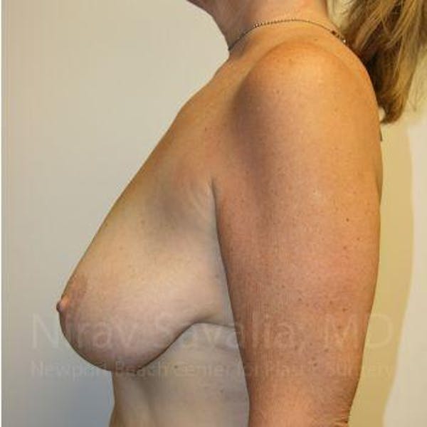 Breast Lift without Implants Before & After Gallery - Patient 1655450 - Before1