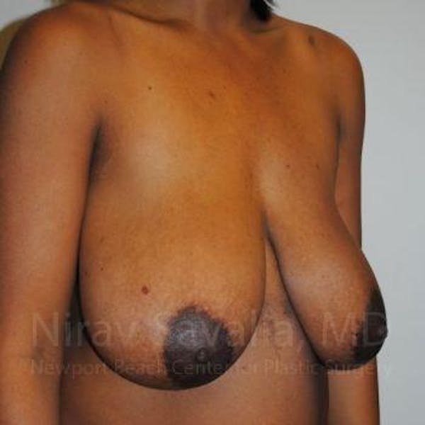 Breast Reduction Before & After Gallery - Patient 1655451 - Before1