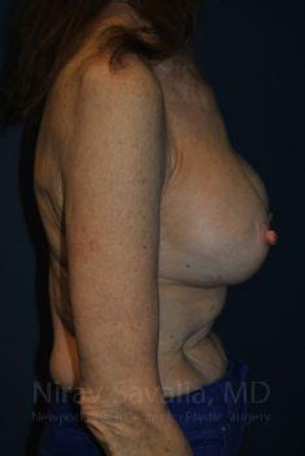 Breast Implant Revision Before & After Gallery - Patient 1655452 - Before1