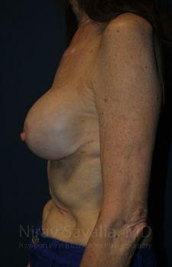 Breast Implant Revision Before & After Gallery - Patient 1655452 - Before1