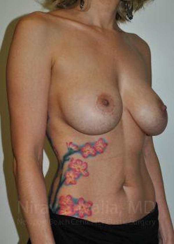 Breast Lift with Implants Before & After Gallery - Patient 1655455 - Before1
