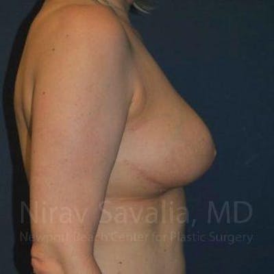 Breast Reduction Before & After Gallery - Patient 1655461 - After1