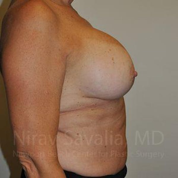 Breast Implant Revision Before & After Gallery - Patient 1655463 - Before1