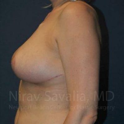 Breast Reduction Before & After Gallery - Patient 1655461 - After1