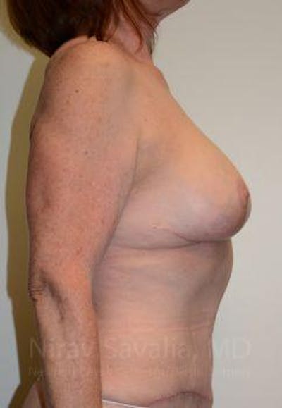 Breast Lift with Implants Before & After Gallery - Patient 1655458 - After1