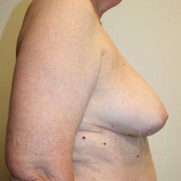 Oncoplastic Reconstruction Before & After Gallery - Patient 1655457 - Before1