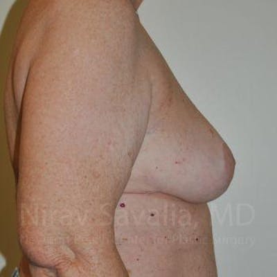 Oncoplastic Reconstruction Before & After Gallery - Patient 1655457 - After1