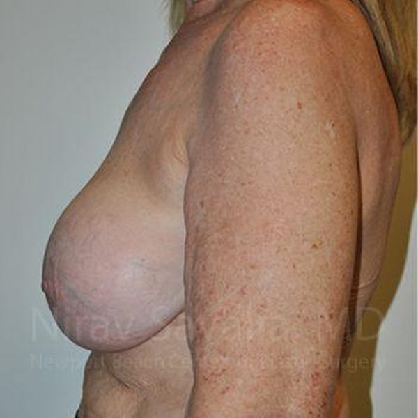 Breast Explantation En Bloc Capsulectomy Before & After Gallery - Patient 1655462 - Before1