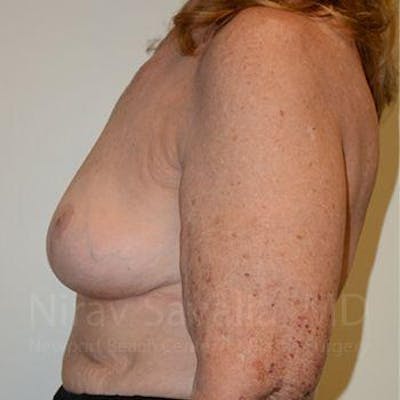 Breast Explantation En Bloc Capsulectomy Before & After Gallery - Patient 1655462 - After1