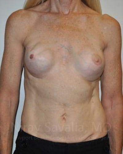 Mastectomy Reconstruction Revision Before & After Gallery - Patient 1655466