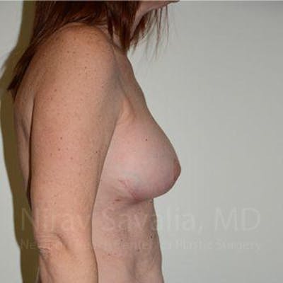 Breast Lift with Implants Before & After Gallery - Patient 1655467 - After1