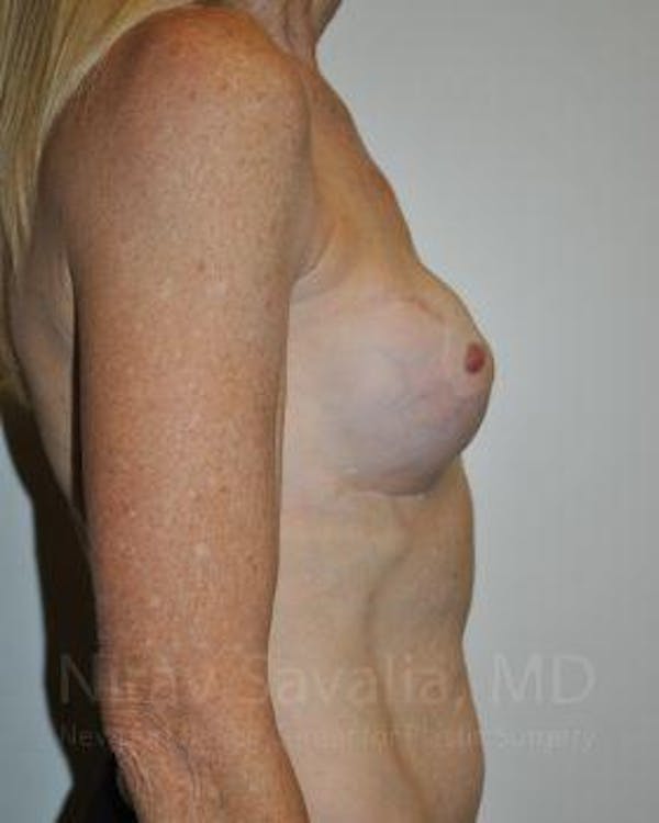  Before & After Gallery - Patient 1655466 - Before1