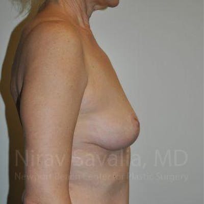 Breast Lift without Implants Before & After Gallery - Patient 1655472 - After1