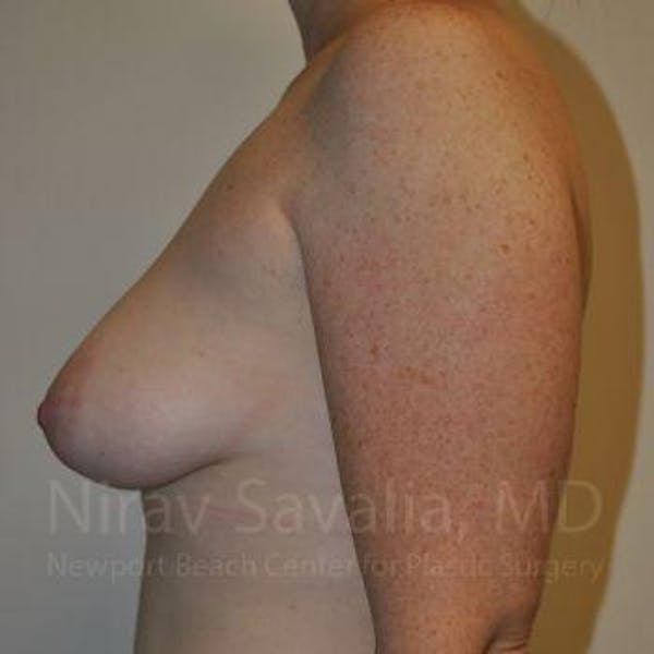 Mastectomy Reconstruction Before & After Gallery - Patient 1655468 - Before1