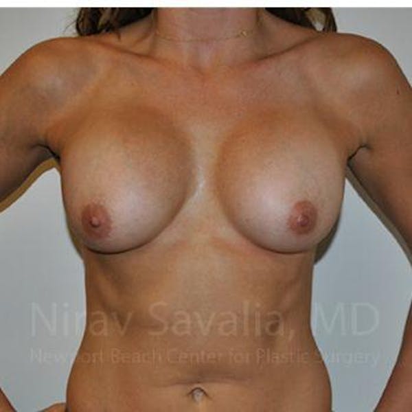 Breast Implant Revision Before & After Gallery - Patient 1655470 - Before1