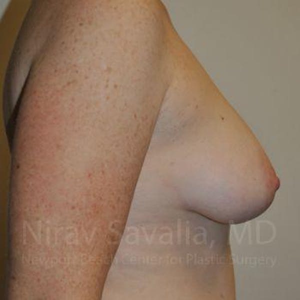 Mastectomy Reconstruction Before & After Gallery - Patient 1655468 - Before1