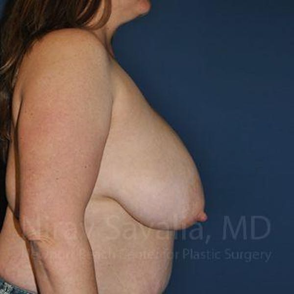  Before & After Gallery - Patient 1655476 - Before1