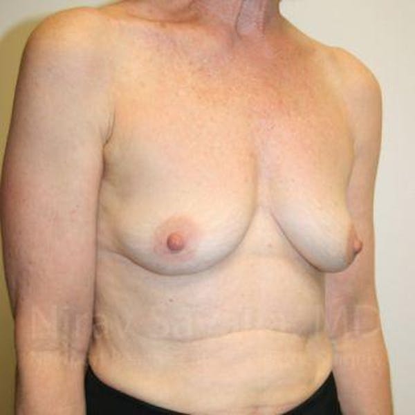 Oncoplastic Reconstruction Before & After Gallery - Patient 1655475 - Before1