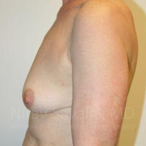 Oncoplastic Reconstruction Before & After Gallery - Patient 1655475 - Before1
