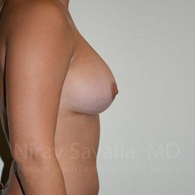 Breast Augmentation Before & After Gallery - Patient 1655477 - After1