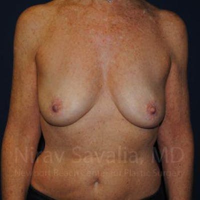 Oncoplastic Reconstruction Before & After Gallery - Patient 1655481