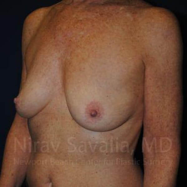 Oncoplastic Reconstruction Before & After Gallery - Patient 1655481 - Before1