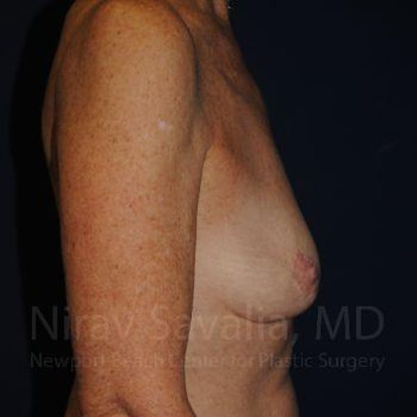 Oncoplastic Reconstruction Before & After Gallery - Patient 1655481 - Before1