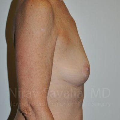 Oncoplastic Reconstruction Before & After Gallery - Patient 1655481 - After1