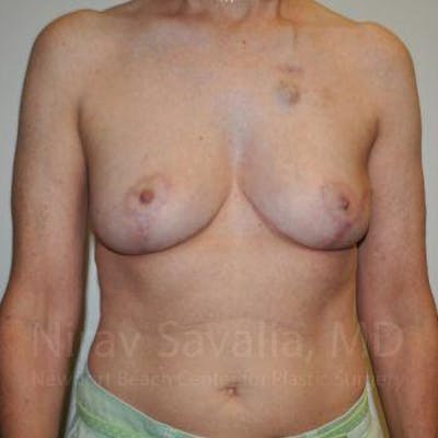 Oncoplastic Reconstruction Before & After Gallery - Patient 1655487 - After1