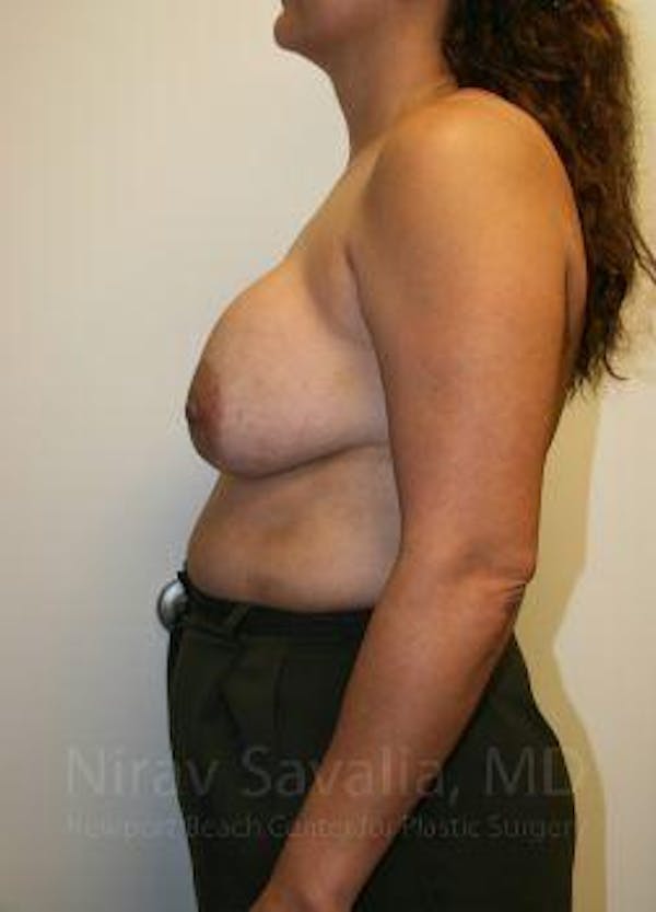 Breast Lift with Implants Before & After Gallery - Patient 1655490 - Before1