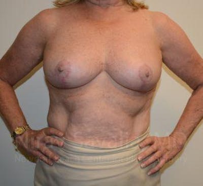 Breast Reduction Before & After Gallery - Patient 1655496 - After1