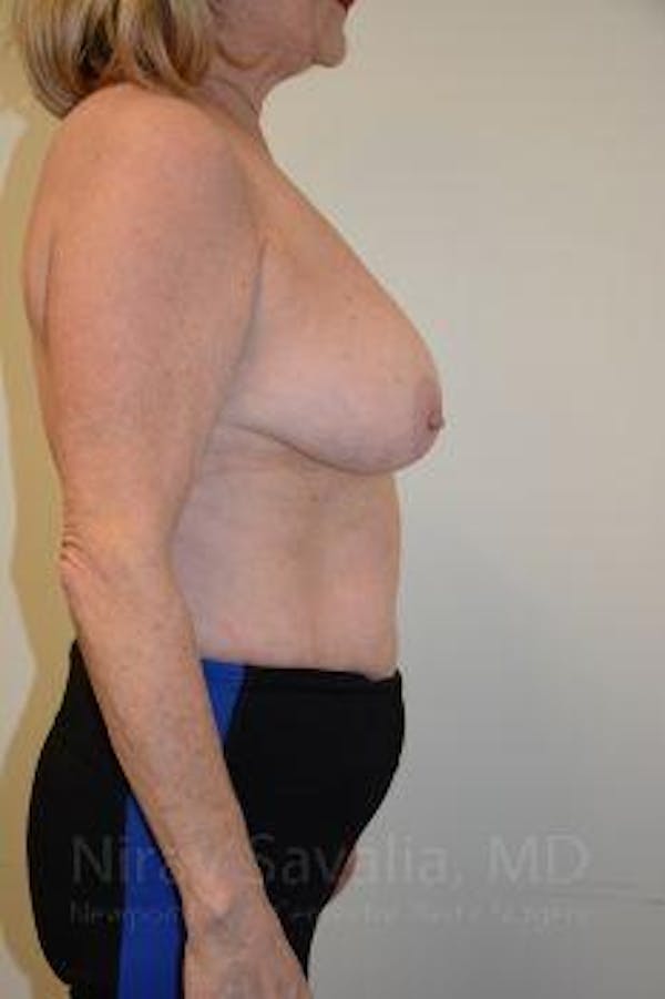 Breast Reduction Before & After Gallery - Patient 1655496 - Before1