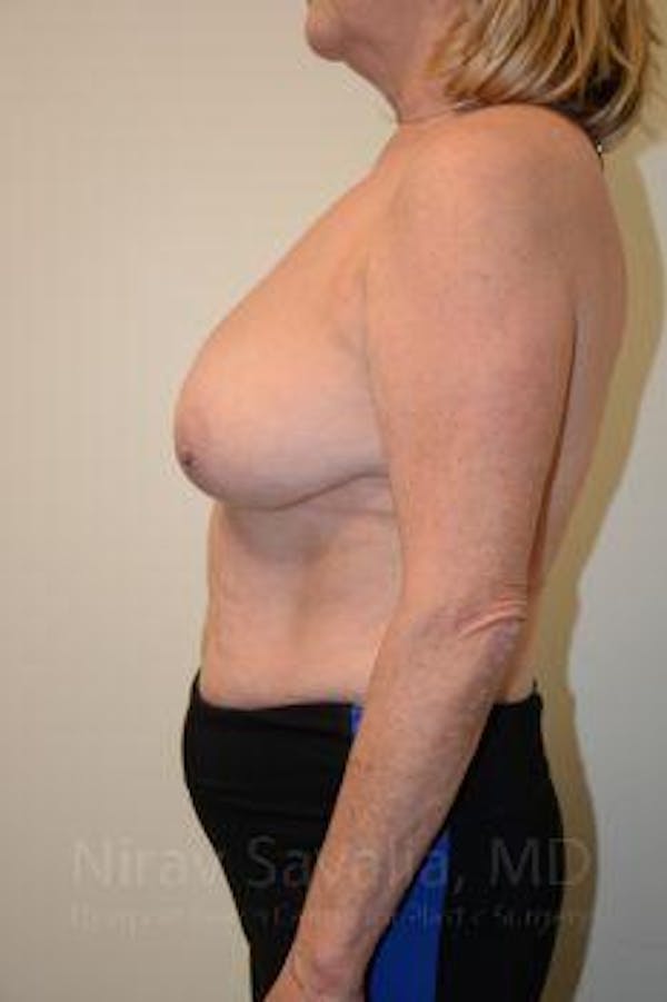 Breast Reduction Before & After Gallery - Patient 1655496 - Before1