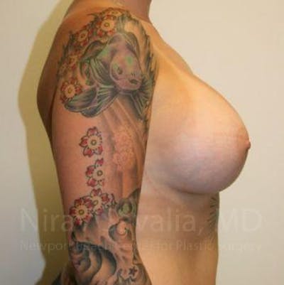 Breast Augmentation Before & After Gallery - Patient 1655500 - After1