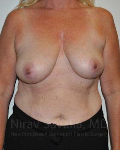 Oncoplastic Reconstruction Before & After Gallery - Patient 1655499