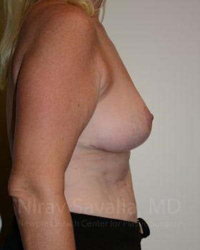 Oncoplastic Reconstruction Before & After Gallery - Patient 1655499 - After1
