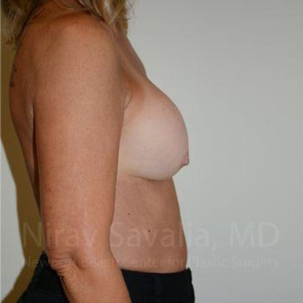 Breast Implant Revision Before & After Gallery - Patient 1655503 - Before1