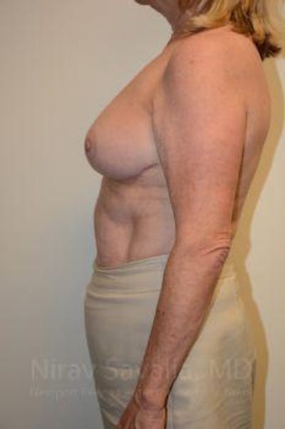 Breast Lift without Implants Before & After Gallery - Patient 1655501 - After1