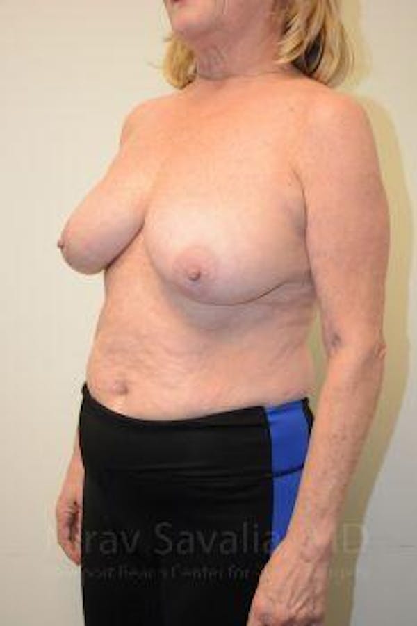 Breast Lift without Implants Before & After Gallery - Patient 1655501 - Before1