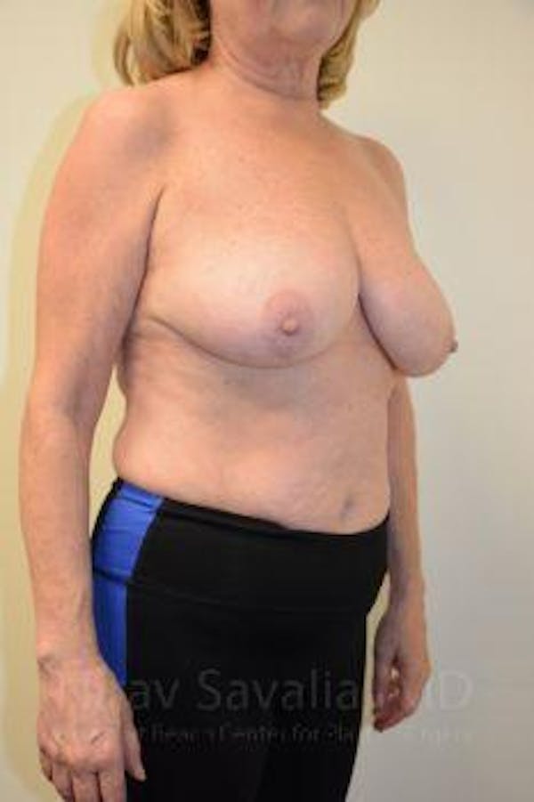 Breast Lift without Implants Before & After Gallery - Patient 1655501 - Before1