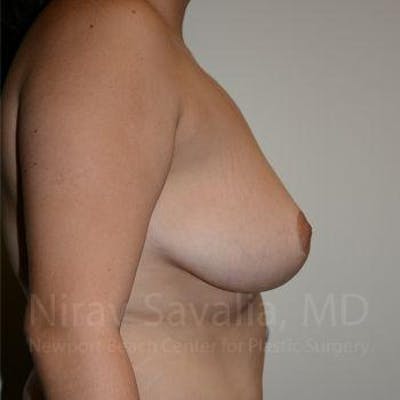 Breast Reduction Before & After Gallery - Patient 1655504 - After1