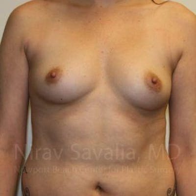 Breast Augmentation Before & After Gallery - Patient 1655506