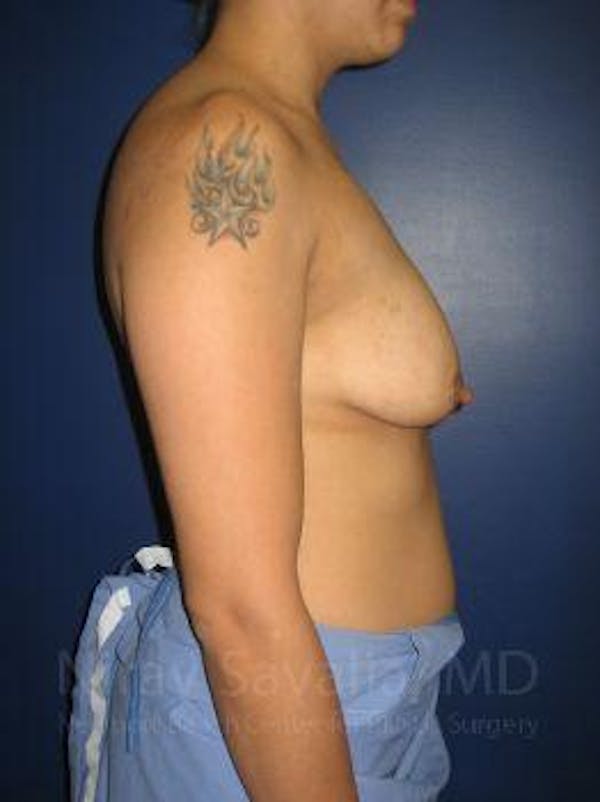 Breast Lift with Implants Before & After Gallery - Patient 1655508 - Before1