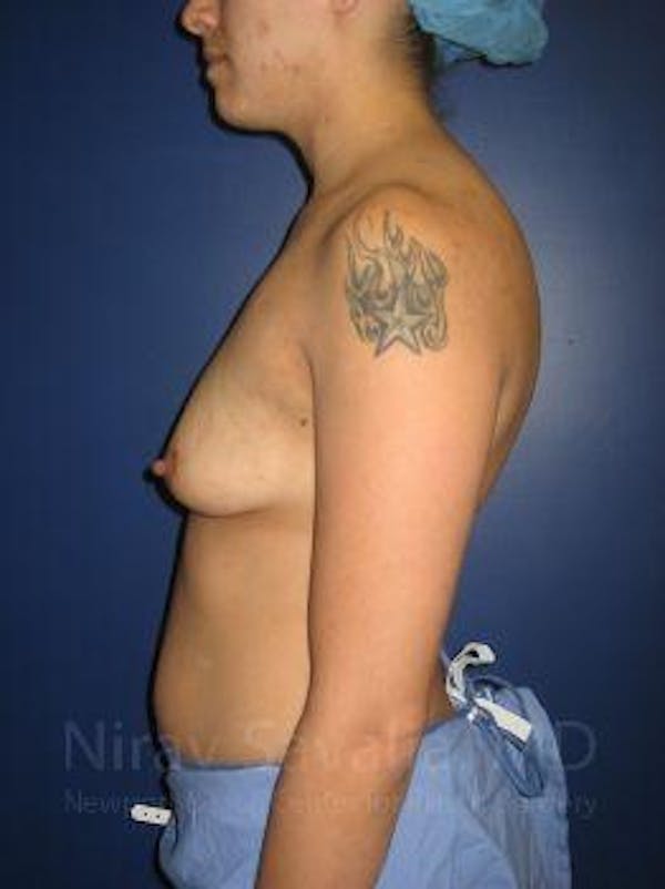 Breast Lift with Implants Before & After Gallery - Patient 1655508 - Before1