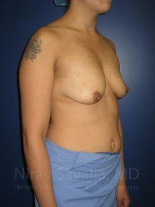 Breast Lift with Implants Before & After Gallery - Patient 1655508 - Before1