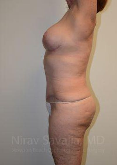 Breast Lift without Implants Before & After Gallery - Patient 1655509 - After1