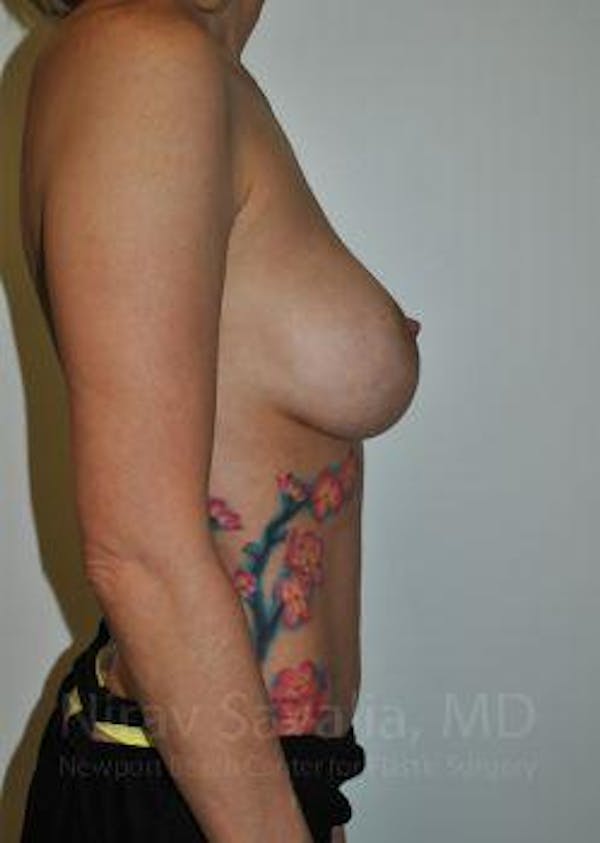 Breast Implant Revision Before & After Gallery - Patient 1655507 - Before1